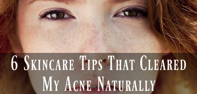 6 Skincare Tips That Cleared My Acne Naturally