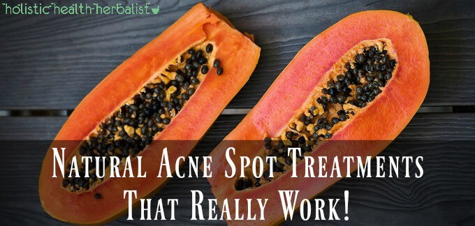 Natural Acne Spot Treatments That Really Work!