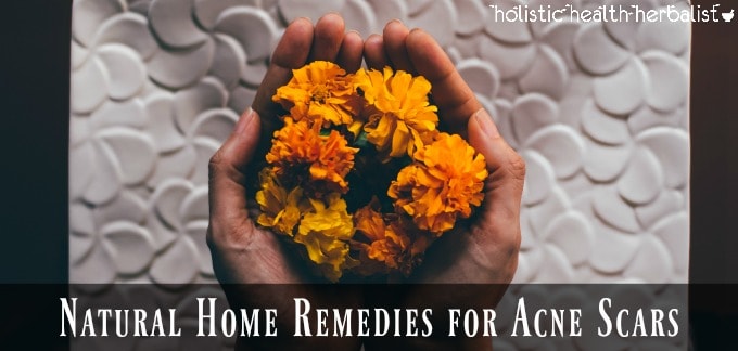 Natural Home Remedies for Acne Scars