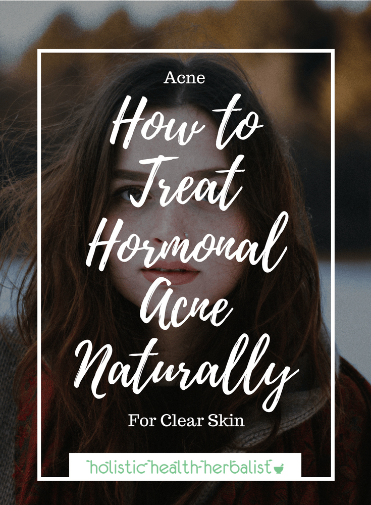 How to Treat Hormonal Acne Naturally - These are my tips and tricks that help control and ultimately heal hormonal acne breakouts - for good!