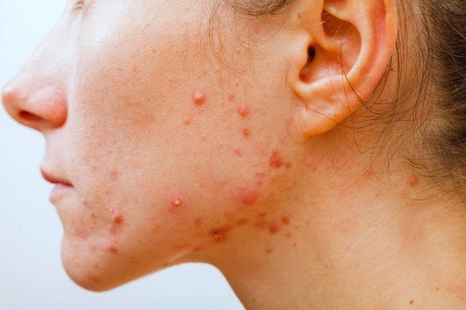 hormonal acne pictures - jawline acne hormonal imbalance photo