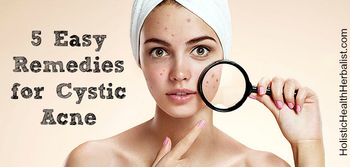 5 cystic acne remedies