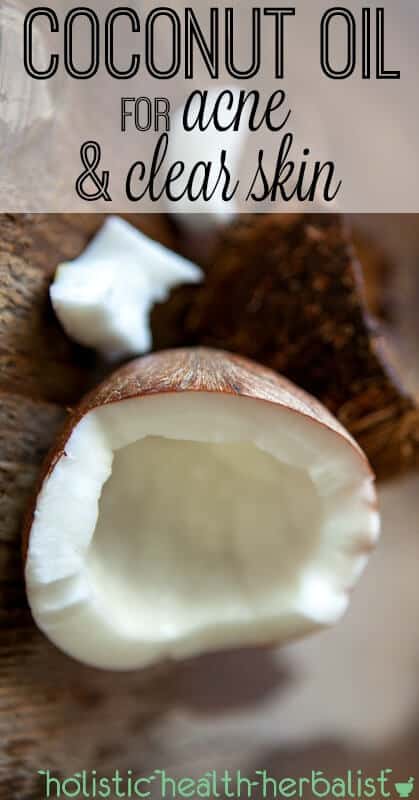 Coconut Oil for Acne and Clear Skin - Using coconut oil for acne is one of the best ways to kill acne causing bacteria, reestablish your skin's natural acid mantle, and moisturize without the chemicals. #coconutoil #acne