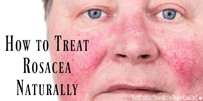 How to Treat Rosacea Naturally for Good!