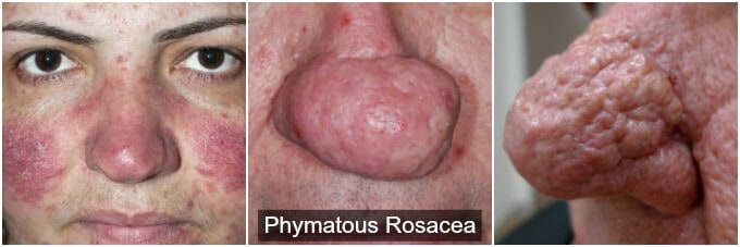 Phymatous Rosacea