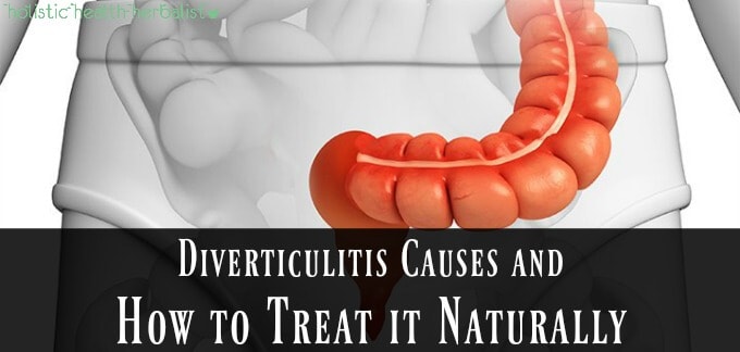 Diverticulitis Causes and How to Treat it Naturally