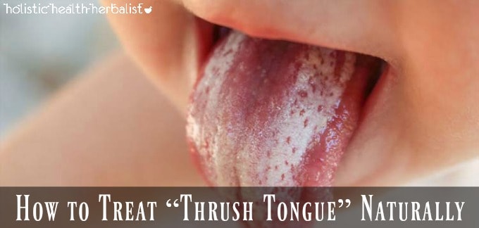 Treat “Thrush Tongue” Naturally 2